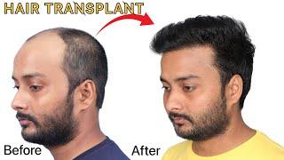 BEST HAIR TRANSPLANT RESULTS EVER || Hair Transplant cost in India | High 6th Grade Baldness |