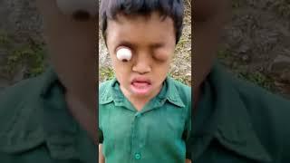 Cậu bé mắt lồi