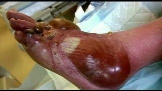 Pus Filled Blisters - Bizarre ER