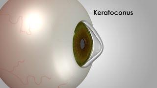 Keratoconus: The Danger of Eye Rubbing