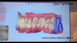 Digital Scans: The Future of Dentistry