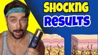 NEW Help For Skin Stress Marks, Cellulite, & Crepiness  | Chris Gibson