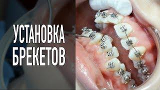 Установка брекетов – макро съемка только у нас! Брекеты Самара