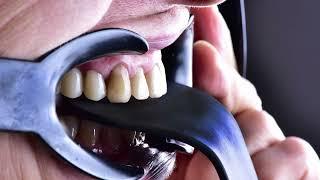 Creation of natural looking teeth using Veneers and zirconia crowns