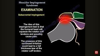 Understanding Shoulder Impingement: Symptoms, Tests, Treatment, and Surgery