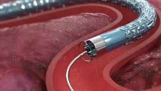 Neurovascular Access Catheter 3D Animation - Infuse Medical