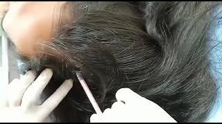 Hair PRP therapy in zirakpur | The Skin Zeal | 72-93-93-93-26