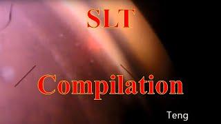 Selective Laser Trabeculoplasty (SLT) Compilation. Chris Teng, MD