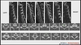 Neuroradiology for Spine Surgeons:  presented by Daniel Riew, MD