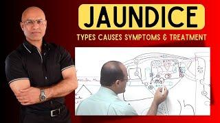 Jaundice | Types Causes Symptoms and Treatment