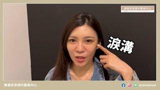 玻尿酸淚溝＋蘋果肌｜雅苑明萃醫美診所