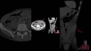 Spigelian Hernia #meded #emergencymedicine #generalsurgery #trauma #medstudent