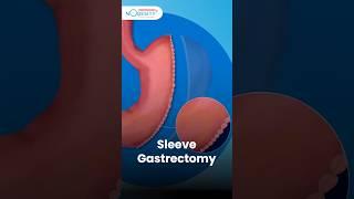 Which Weight Loss Surgery Is Best? Dr. Manish Khaitan Explains Safe & Effective Options