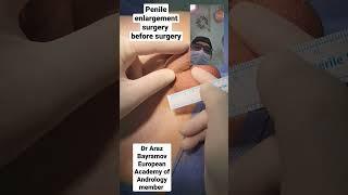 Penile enlargement surgery results before surgery Dr Araz Bayramov www.penilenlargement.com