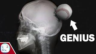 How a Baseball Injury Made A Genius (Savant Syndrome)