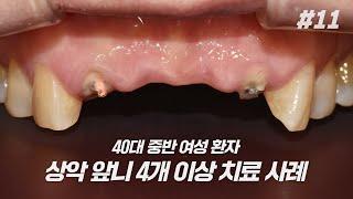 40대 환자의 상악 앞니 임플란트 치료 사례