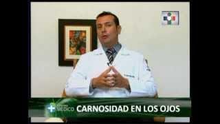 Pterigión - Dr. Carlos Rojas Marin Director - CLINICA DE OJOS OFTALMOVISION - Trujillo-Perú