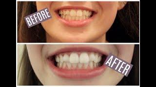 Activated Charcoal Teeth Whitening Using Carbon Coco Products: Before&After, and Impressions!