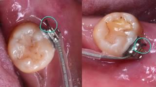 Clinical Tip: How to Secure the Wire End by Dr. Ashley Huang｜【Chris Chang Ortho】CC427