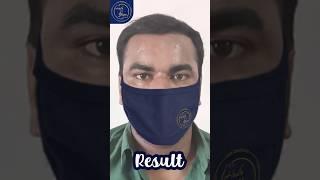 7 Month Amazing Hair Transplant Result || The Hair And Shape Clinic || Dr. Umang Kothari