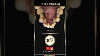 Management of Constricted Mandibular Arch using SELFY LINGUAL SYSTEM