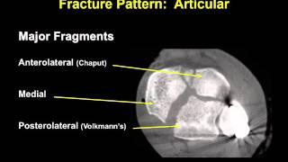 Tibial pilon fractures 1