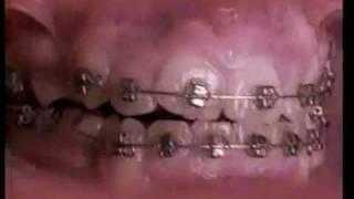 18 mois d'orthodontie en accéléré