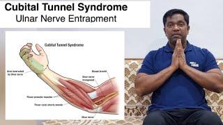 cubital tunnel  syndrome # dr s.k.sharma M.S ortho