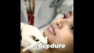 Lip fillers procedure | lip fillers shorts | #Shorts | #YouTubeShorts