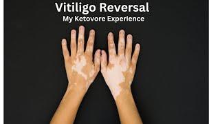 HOW I REVERSE MY VITILIGO: June 2023 Update (Diet, Supplements, Exercise, Meditation)