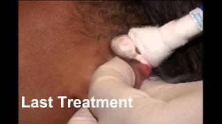 Ear Keloid treatment with CryoTherapy by keloid specialist Dr  Michael Tirgan, New York