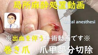 巻き爪・陥入爪の処置動画　局所麻酔下に爪甲部分切除　/   Partial excision of the nail under local anesthesia