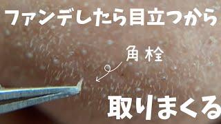 【角栓】毛穴落ち？いや出てる。ファンデして2時間。目立つから角栓ぬいたった