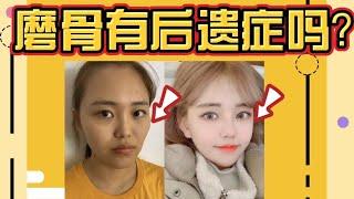 【韩国整形】磨骨会有什么后遗症？关于磨骨的知识？