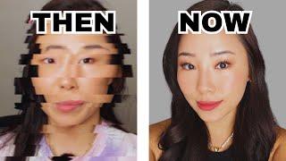 ... I GOT PLASTIC SURGERY IN KOREA