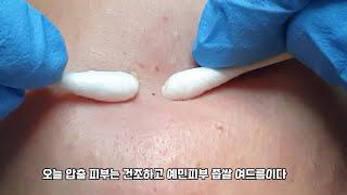 좁쌀 여드름 압출  건조하고 예민한  좁쌀여드름 !!