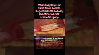 Heart ️ drilling with Diamond  #shorts #viral #trending #heart #angioplasty #angiography