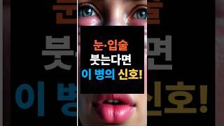 “눈·입술 붓는다면 ‘이 병’!”#얼굴붓기#눈붓기#입술붓기#여름건강#붓기원인#쇼그렌증후군#혈관부종#자가면역질환#전신질환#여름질병#여름병주의보#건강쇼츠