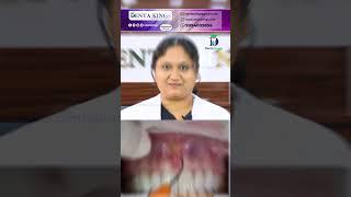 லேசர் பல் சிகிச்சை வலிக்குமா வலிக்காதா? -  Does Laser makes dental treatment Painless? | Denta Kings