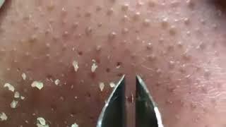 Pimple Popping & Blackhead Removal Madness!