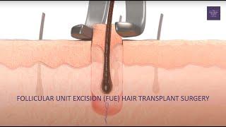 What is an FUE hair transplant?