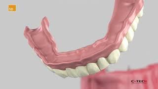 SD Small Diameter - Surgical Protocol