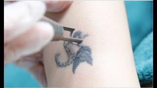 HOW DOES LASER TATTOO REMOVAL WORK