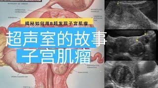 超声室的故事: 子宫肌瘤 【Ultrasound Room】Diagnosing Uterine Fibroids on Ultrasound