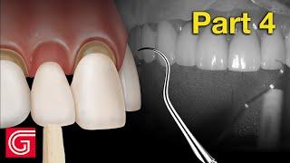 HOW TO Try-In Zirconia Crowns BEFORE Final Cementation