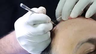 How Hair Transplant Works? Eugenix Hair Sciences