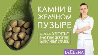 ЖКБ. Камни в желчном пузыре. Билиарный сладж, застой желчи, хлопья в желчном пузыре. УДХК | Урсосан.