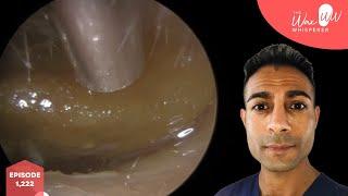 1,222 - Massively Blocked Ear Wax Removal