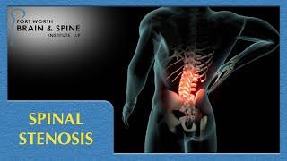 Fort Worth Brain and Spine Institute - Spinal Stenosis