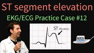 ST Elevation - EKG / ECG Interpretation Case 12 (STEMI, MI, ACS)